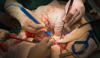 Como o mercado pode diminuir a fila de transplantes?